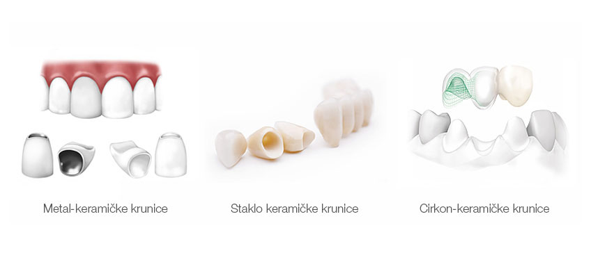 keramicke_krunice_vrste