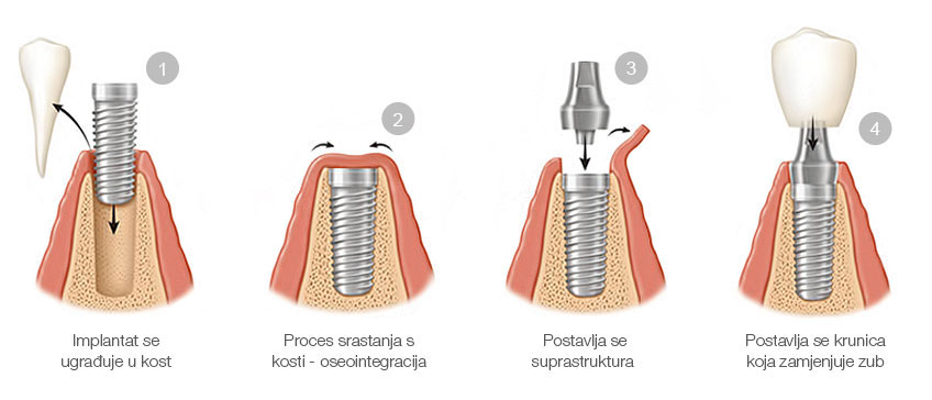 zubni-implantati-proces-ugradnje